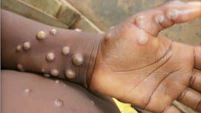 Monkeypox infection UAE